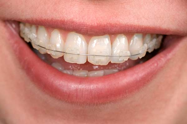 Clear Braces in the Greater Hartford Area