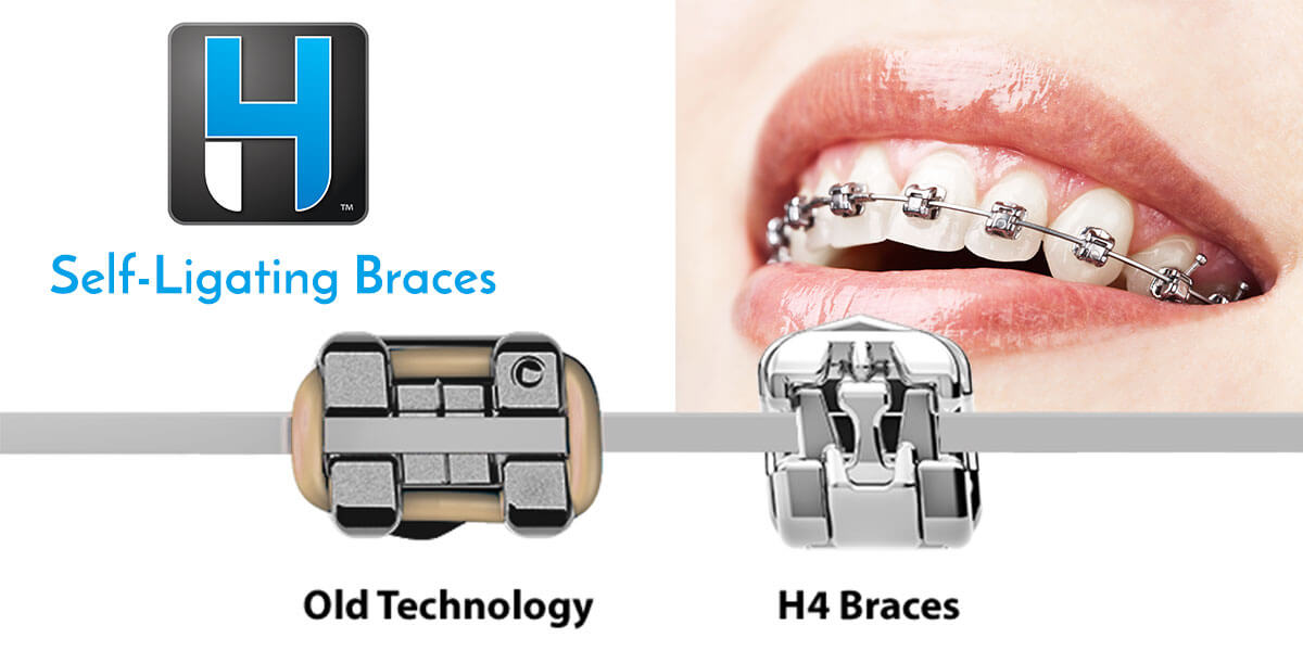 H4 Braces in Newington, Self-Ligating