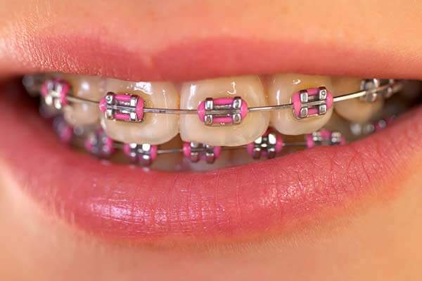 Greater Hartford Orthodontics Services