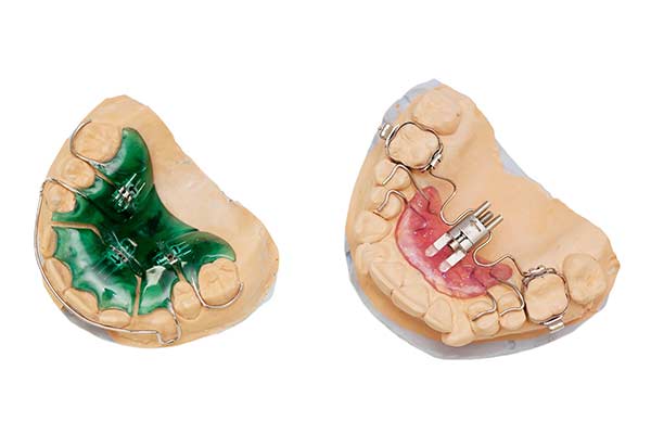 Two Palatal Expander