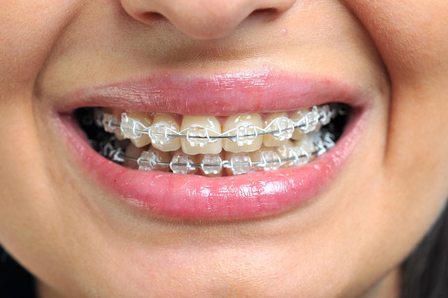 Are Clear Braces Right for Adults With Busy Lifestyles?