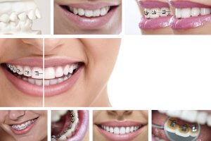 Getting Braces: What You Should Know