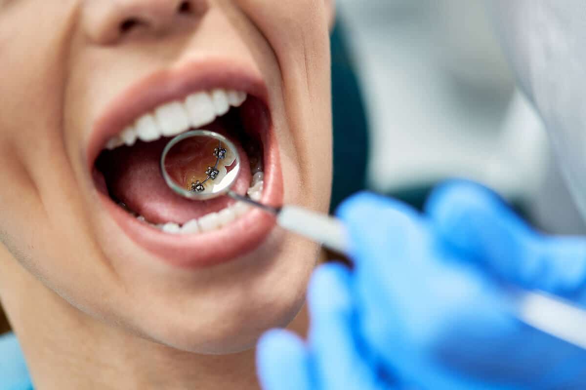 How long do braces take blog.jpg