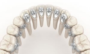 a graphic showing lingual brackets on teeth