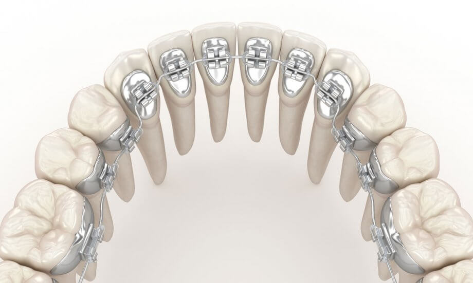 a graphic showing lingual brackets on teeth