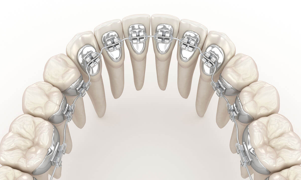 How Quickly Do Lingual Braces Work?