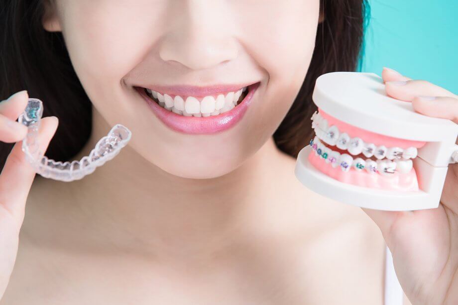 What Are Clear Braces?