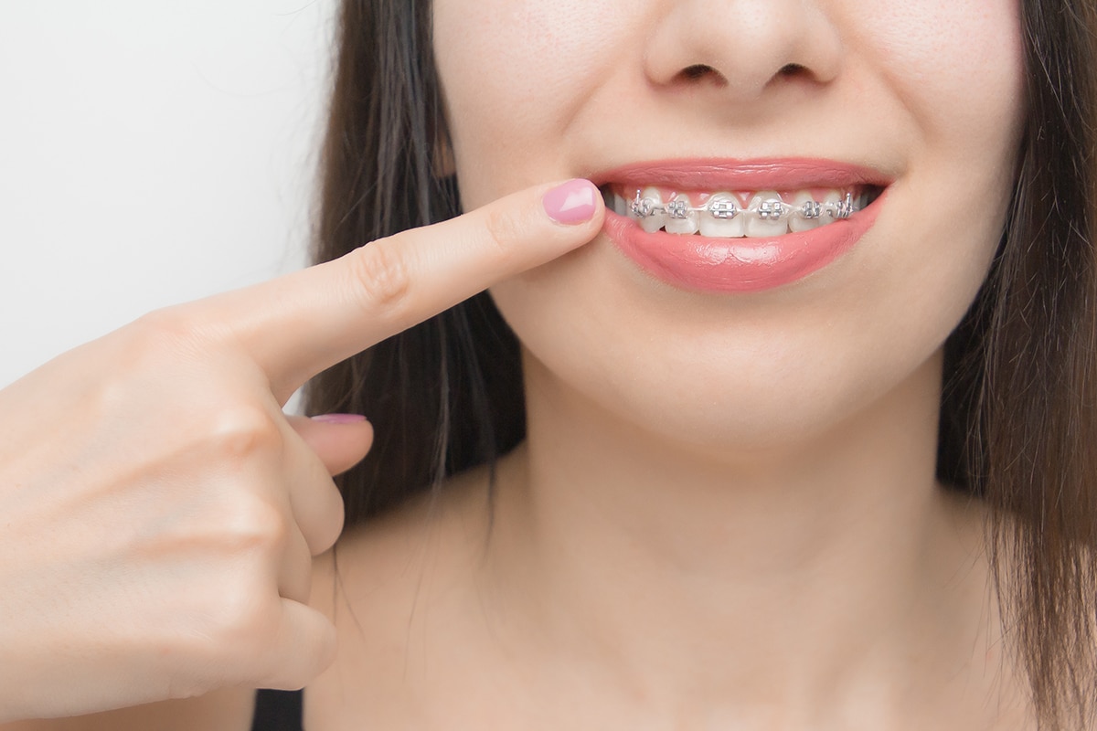 What makes self ligating braces faster than traditional braces blog