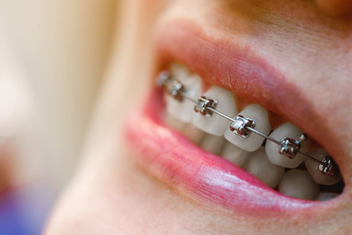 Why self ligating braces are gaining popularity among teens blog